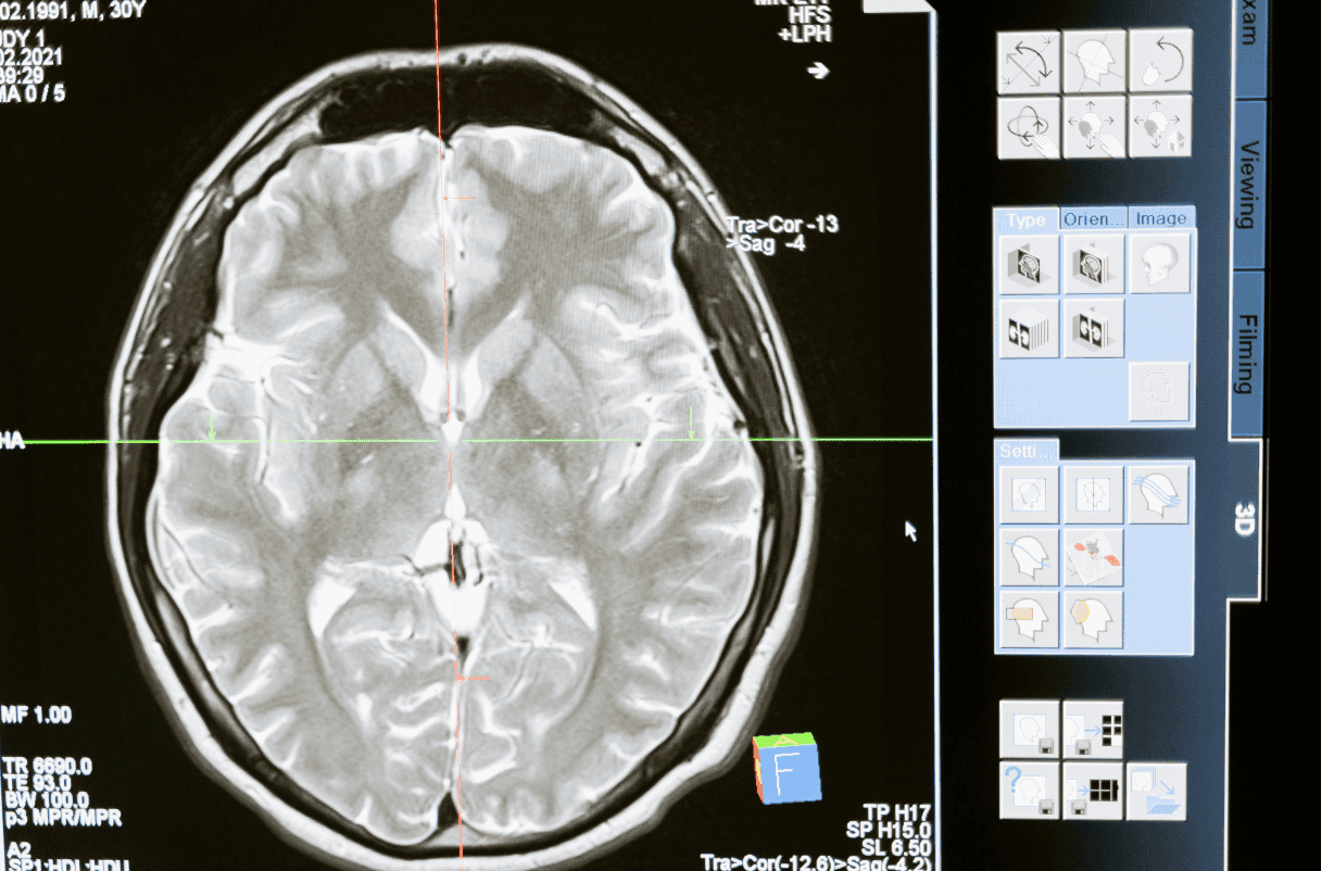 Terapia EEG – biofeedback